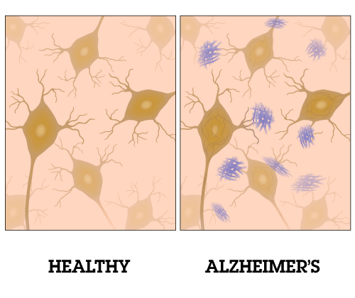 Alzheimera KONOPY