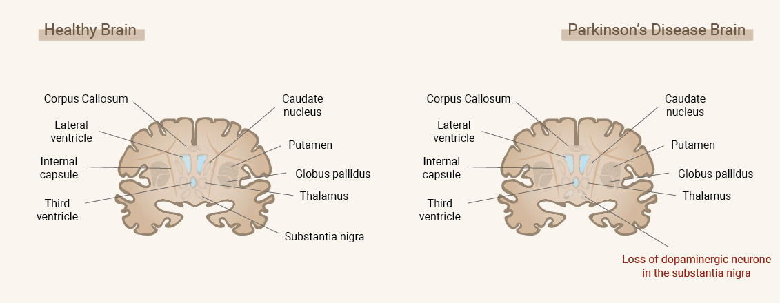 Co to jest choroba Parkinsona? Co to jest choroba Parkinsona?