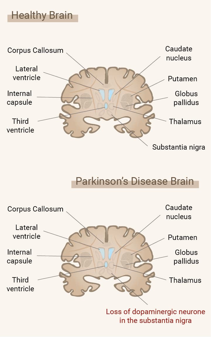 Co to jest choroba Parkinsona?